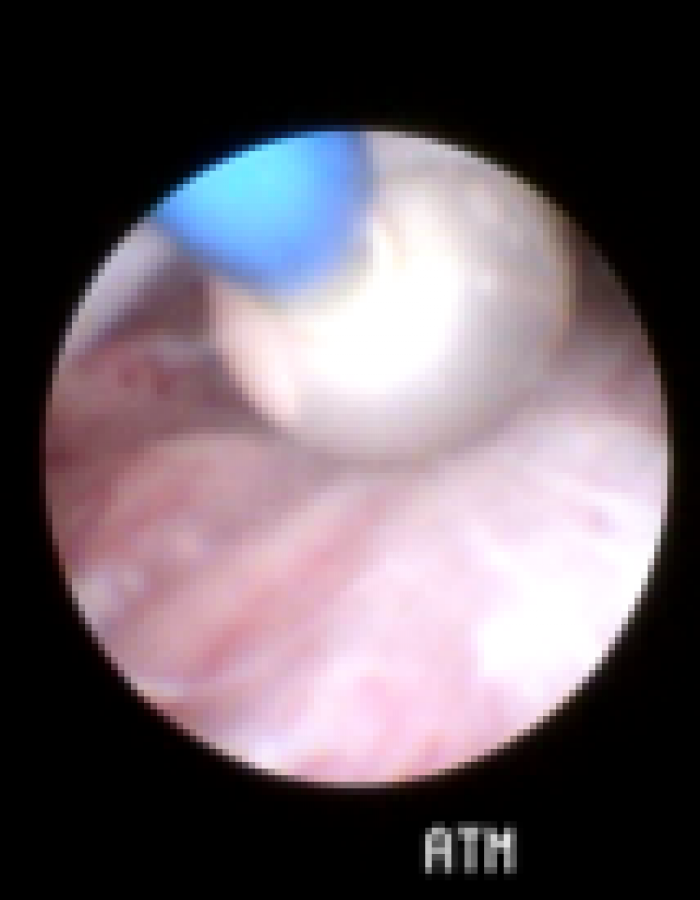 Zugang Epiduralraum